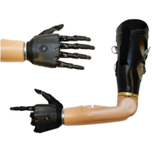 Transhumeral Prosthesis (Above-Elbow)